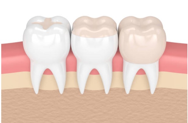 composite fillings