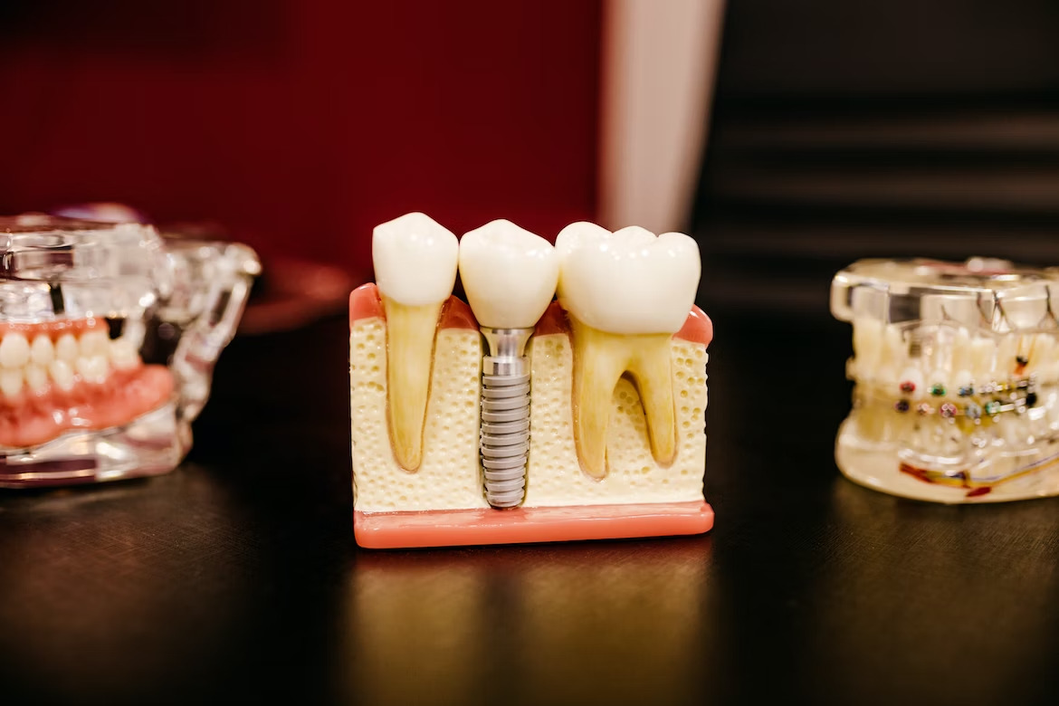 a dental model of an implant