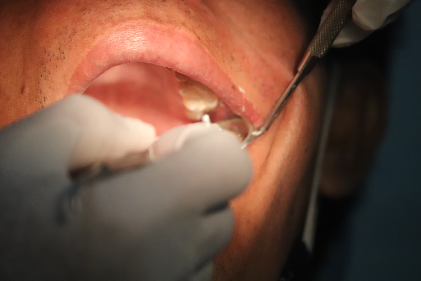 a patient being treated for cavities