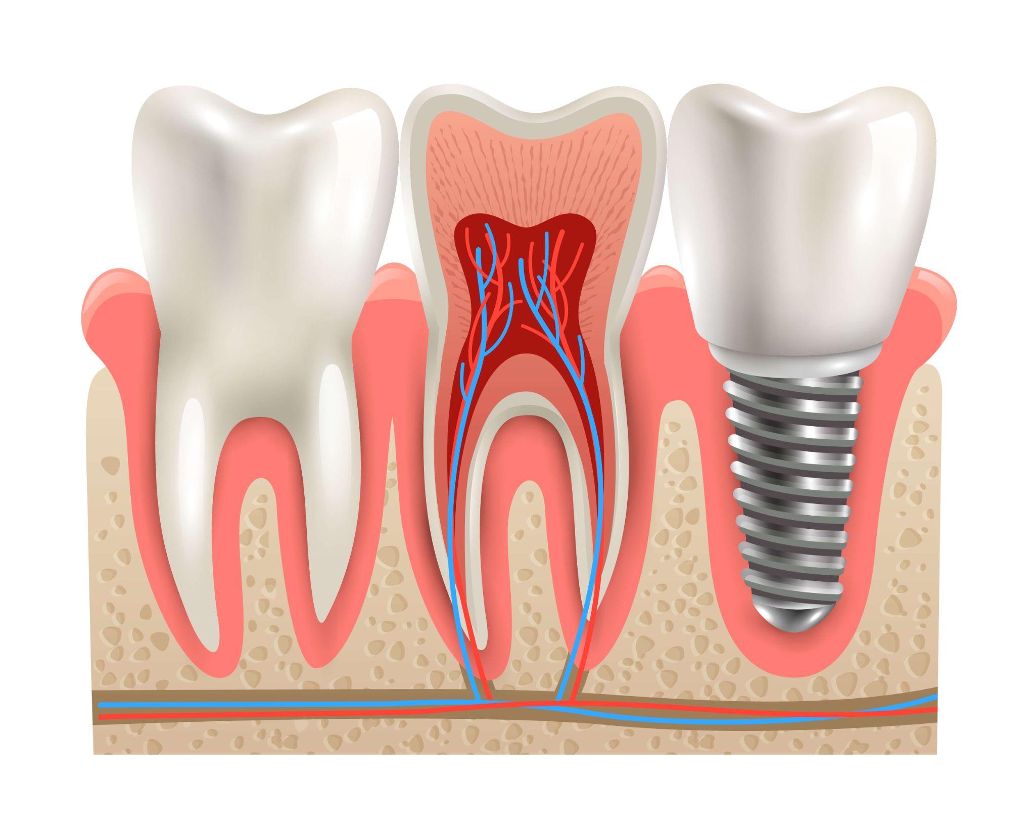 graphic illustration of a dental implant