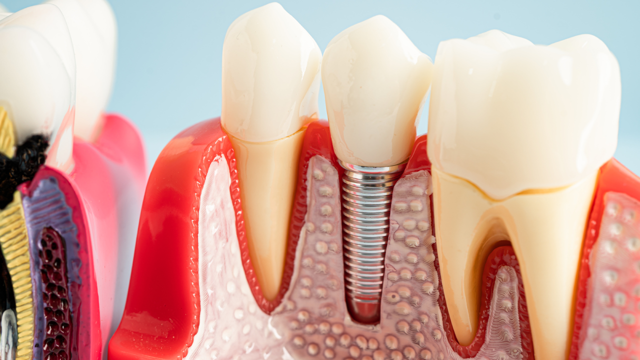 Dental Implants 3 dental implants