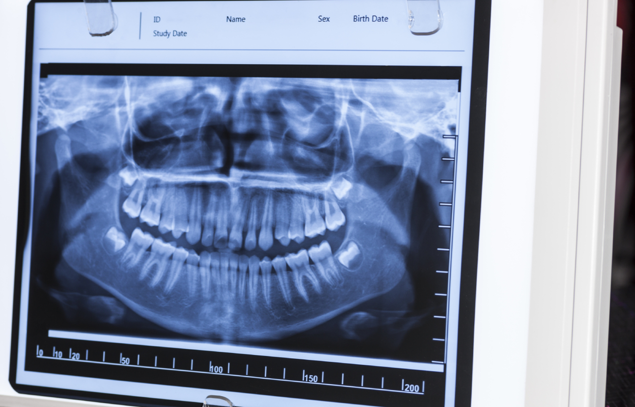 Digital X Ray digital x ray