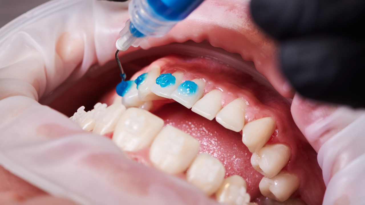Fluoride Treatments 1 fluoride treatments