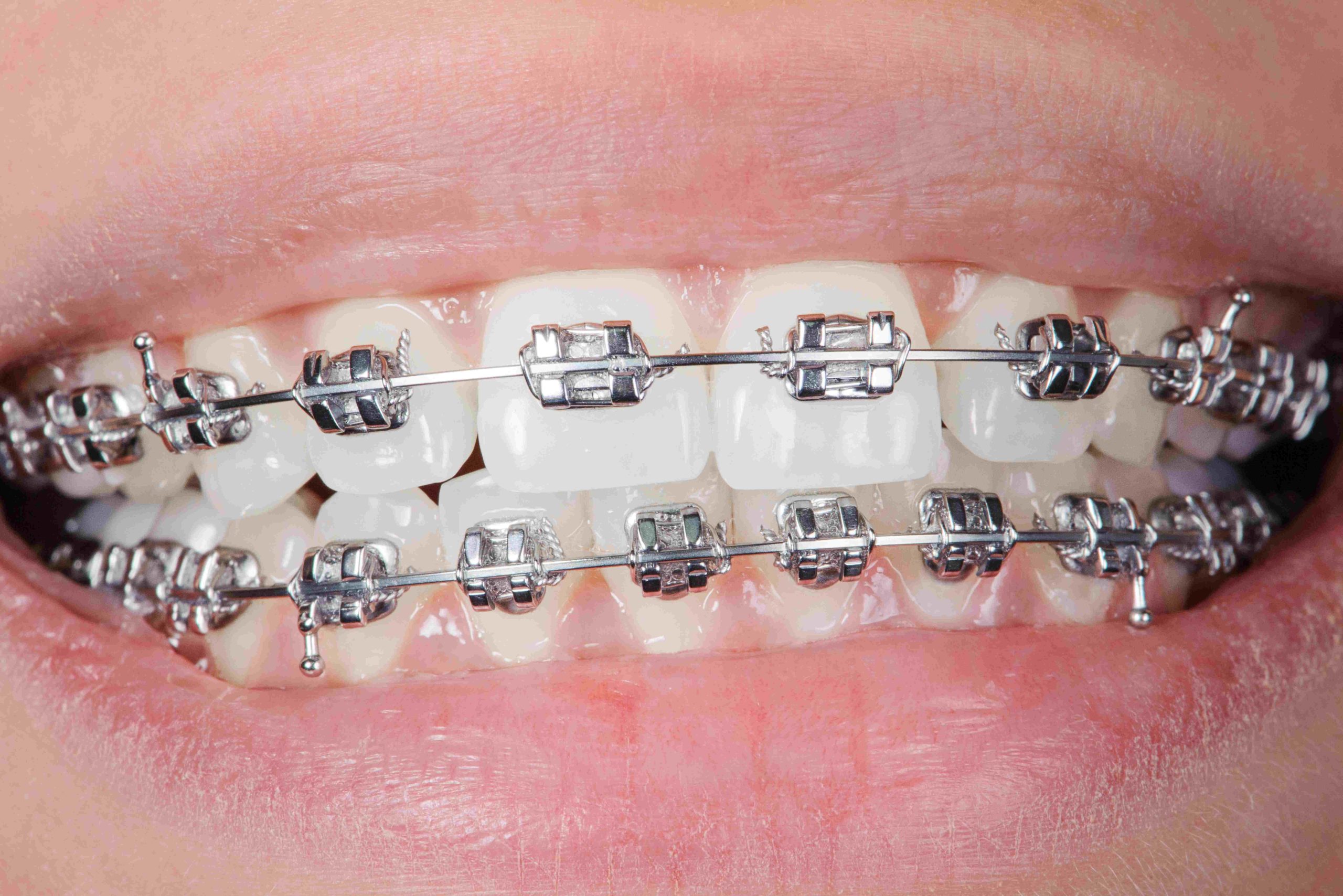 Traditional Braces traditional braces