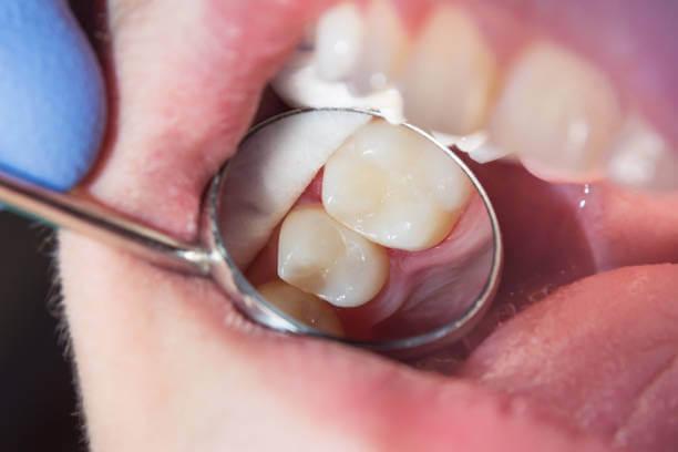 close-up of a tooth with a seamless composite filling, perfectly matching the natural color and texture 