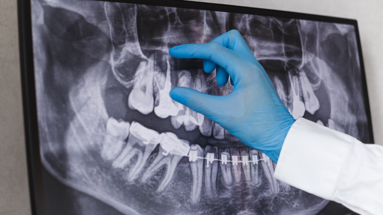 Digital Dental X-Rays vs Film: The Real Benefits